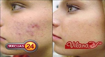 Lieliska iespēja uzlabot ādas stāvokli! Foto ārstēšana - kapilāru tīklojuma ārstēšana uz sejas, pigmentācijas vai akne ārstēšana ar 60% atlaidi!