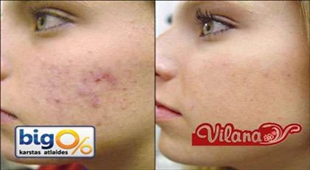 Фото лечение сосудистой сеточки на лице, пигментации или акне -60%! Отличная возможность улучшить состояние кожи!