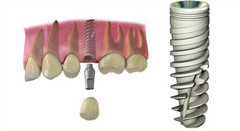 Центр имплантологии стоматологической клиники CITYDENTAL: полный цикл имплантации системой имплантатов AlphaBio  – 40%