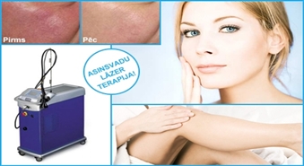 Atbrīvojies no bojātajiem asins vadiem ar lāzerterapijas palīdzību tikai par Ls 5.99 salonā LUKSOR!