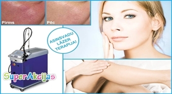 Atbrīvojies no bojātajiem asins vadiem ar lāzerterapijas palīdzību tikai par Ls 5.99 salonā LUKSOR!