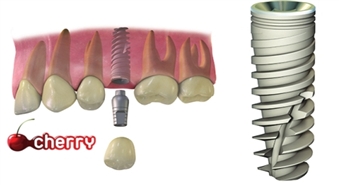 Zobārstniecības klīnikas CITYDENTAL zobu implantu centrs: pilns implantēšanas cikls, izmantojot AlphaBio implantu sistēmu – 40%