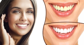 VIP SMILE: zobu balināšana žilbinoši baltam smaidam - 40%