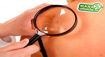 Живите без комплексов! Удаление папиллом и сосудистых звёздочек на 50% дешевле