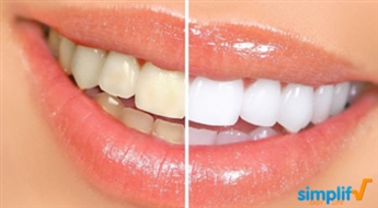 iDental: Фотоотбеливание зубов
