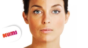 Ārstnieciska procedūra  Age Spot: pigmentēta sejas āda -50%