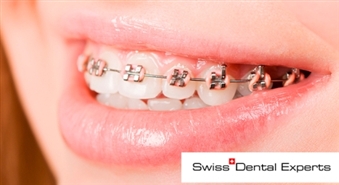 Breketes sākot no Ls 240, iegādājoties ortodonta konsultāciju elitārajā klīnikā SWISS DENTAL EXPERTS - 65%
