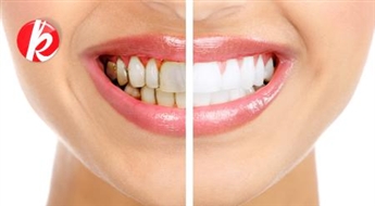Инновационная технология отбеливания зубов WHITE SMILE в центре Старой Риги: Блесни голливудской улыбкой! Французское качество. -68%