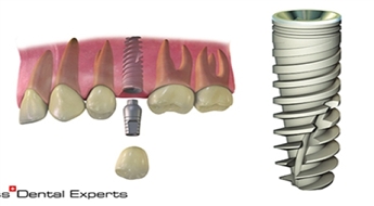 SWISS DENTAL EXPERTS: 35% atlaide (Ls 150 apmērā) MIS zobu implantam + atlaide Ls 70 apmērā metālkeramikas kronim + konsultācija pie sejas-žokļu ķirurga tikai par Ls 9.99!